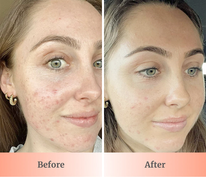 GlowUp™ LED Light Therapy Face Mask